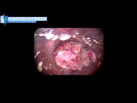 Endoscopic Discectomy of a Huge Sequestered Fragment called " Moby Disc " by Dr. Tony Mork