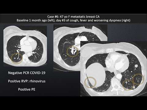Pt. 1 Chest CT Appearance of COVID-19