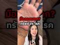 มือลอกบอกอะไร 😳⁉️ #pinzonesuk #handeczema #eczema #มือลอก