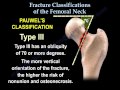 Femoral Neck fracture Classifications - Everything You Need To Know - Dr. Nabil Ebraheim