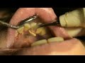 Dental Scale & Polish