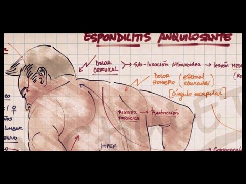 Vídeo: Espondilitis Anquilosante: Manejo Del Dolor Muscular Con Terapia De Masaje