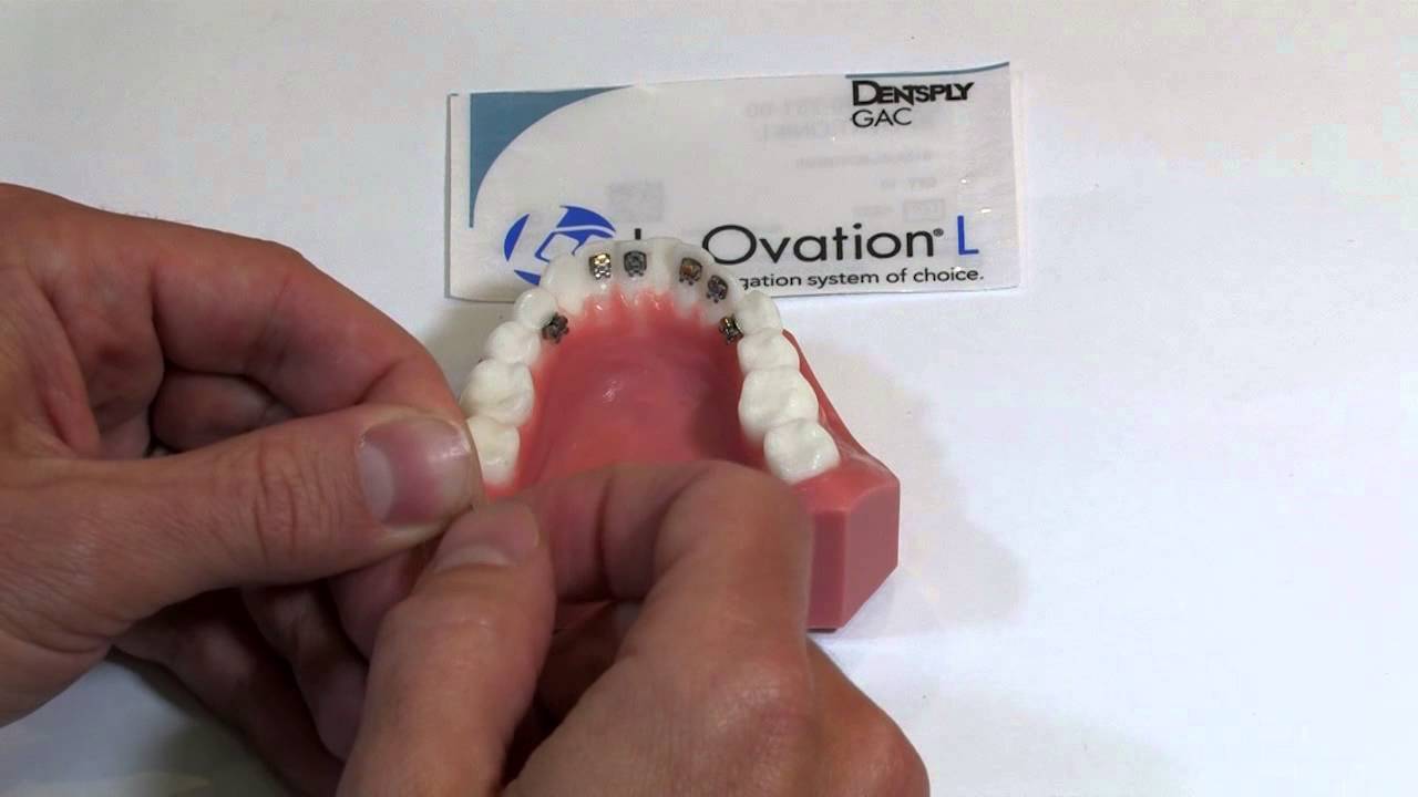 Managing crowding using In-Ovation® L brackets