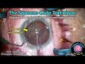 Cataractcoach 2149 the squeeze chop technique