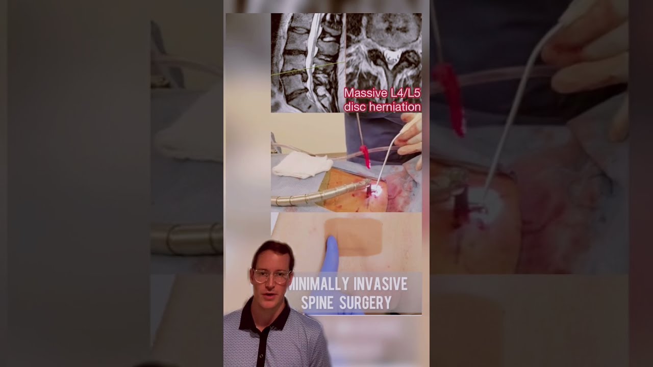 Why minimally invasive spine surgery￼? 🩹😊