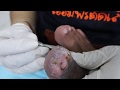 Ep_1434 Big ingrown toenail removal 👣 ตัดแล้ว..หักอยู่ด้านใน 😷 (This clip is from Thailand)