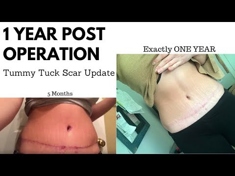 Video: Tummy Tuck Scars: Prevencia, Liečba A Odstránenie