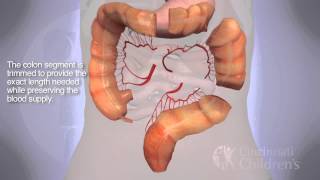 Segmental Colonic Interposition for Esophageal Atresia: 3D Animation