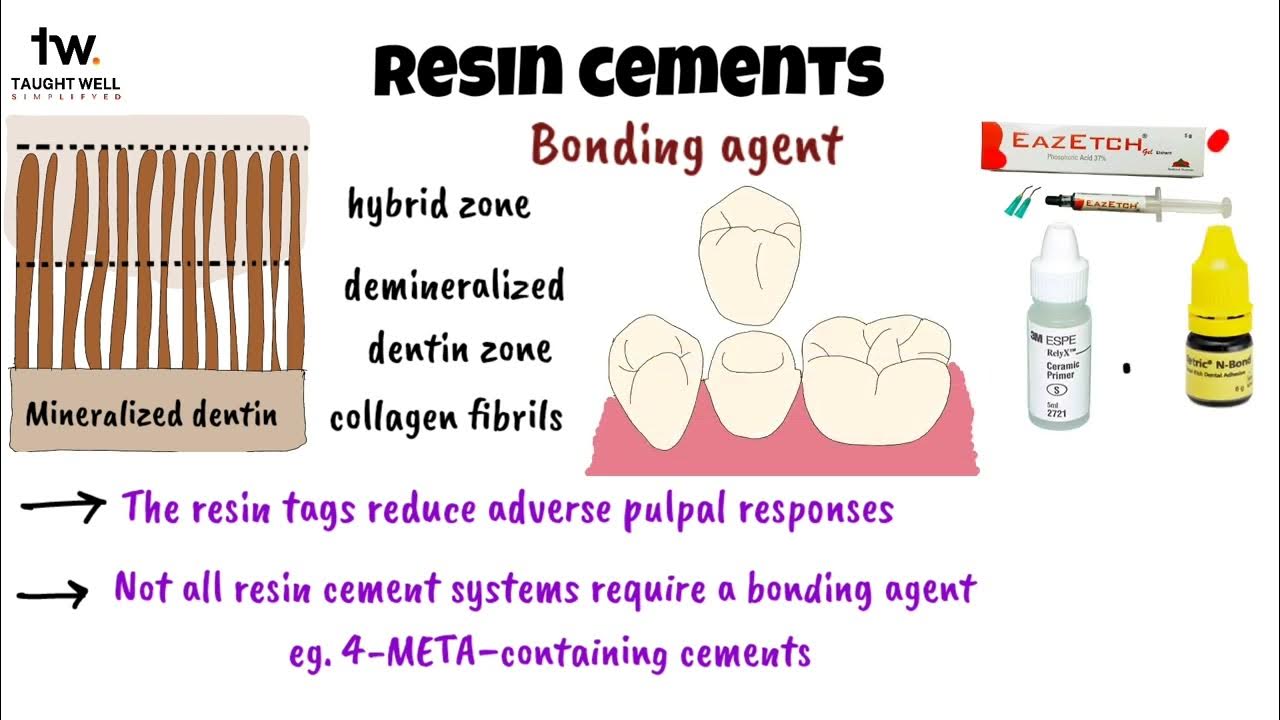 Dental cements Compomers and Resin cements YouTube