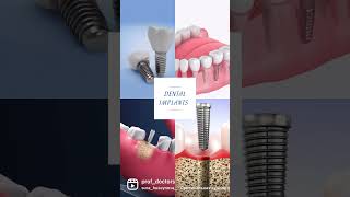 Dental Implant Surgery