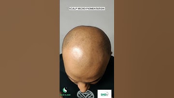 scalp micro pigmentation in Cochin, payyanur,kerala. 79948 80337, 8078800335 #scalpmicropigmentation