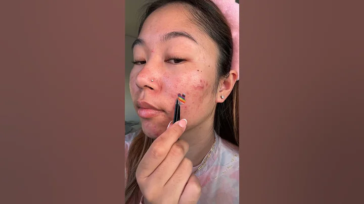 😮‍💨 Pimple patch peel - Pride Dot Edition 🌈✨ #acneproneskin #acne #pimplepatch