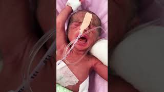 Newborn baby admit in nicu twins 2 female child mild rd #niculife #nicumiracle #nursingcare #neonato