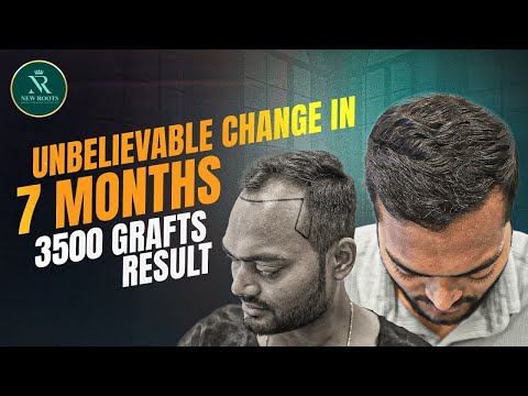 3500 Grafts, 7 Months Result 😎 | Best Hair Transplant Clinic in Nagpur | New Roots