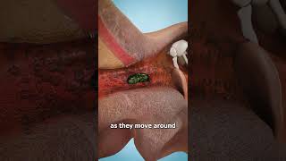 Why Bugs Like Your Ear Canal 😱