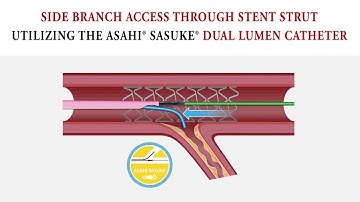 Side Branch Access through Stent Strut: Dual Lumen Technique