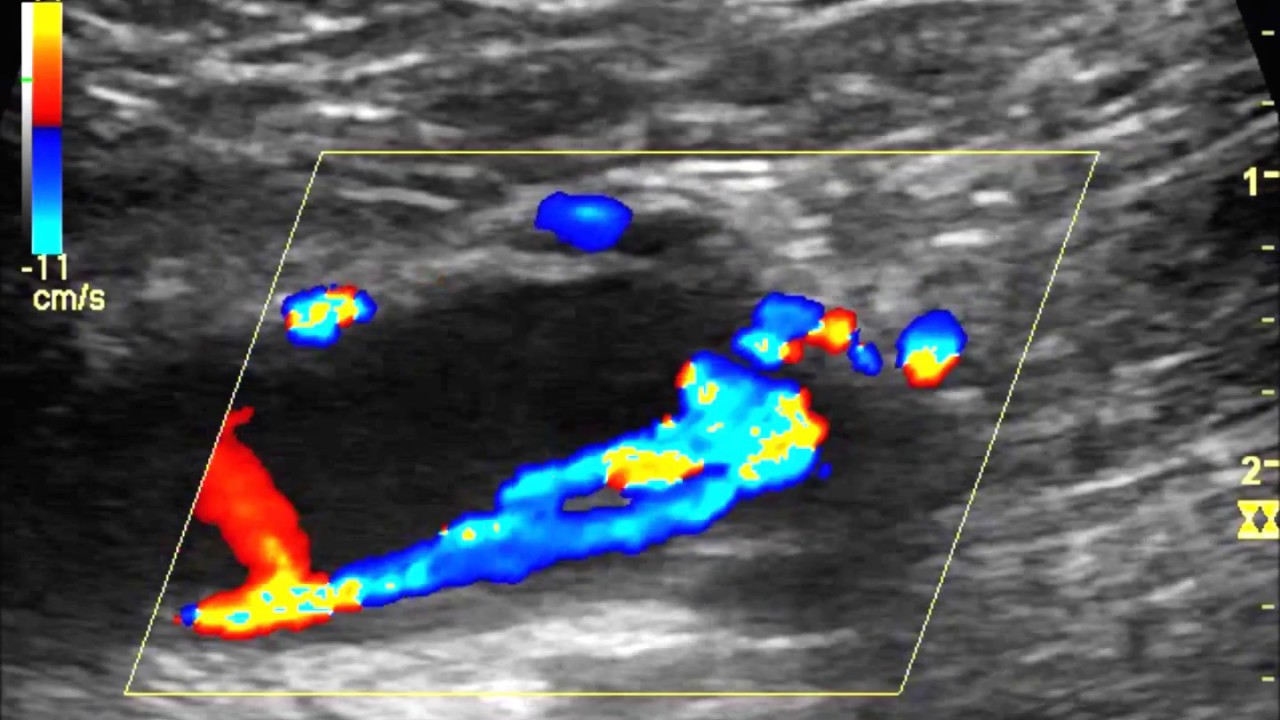 Femoral Av Fistula Ultrasound