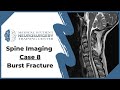 Spine imaging case 8 burst fracture