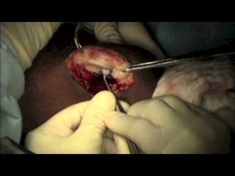 Marc Knee Cartilage Transplant - DeNovo Surgical Technique - Alan S. Nasar, MD - AOSMI
