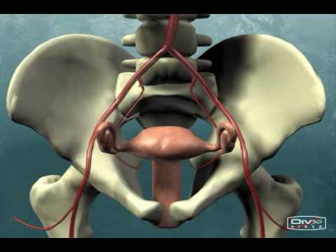 Uterine Fibroid Embolization Animation Video
