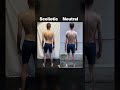 Moving Pain Free, Improving RSI and Correcting Scoliosis - All at The Same Time