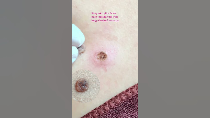 Hướng dẫn đốt mụn thịt Informational, Transactional