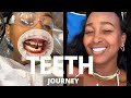 MY TEETH JOURNEY | I GOT PORCELAIN VENEERS | BEFORE AND AFTER PHOTOS | DR. NEAL PATEL | THE YUSUFS