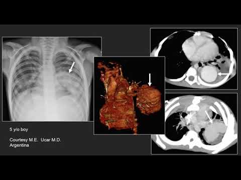 Vídeo: Tuberculosis Pulmonar Perdida: Un Estudio Transversal En Las Salas De Hospitalización Médica General De Un Gran Hospital De Referencia En Etiopía