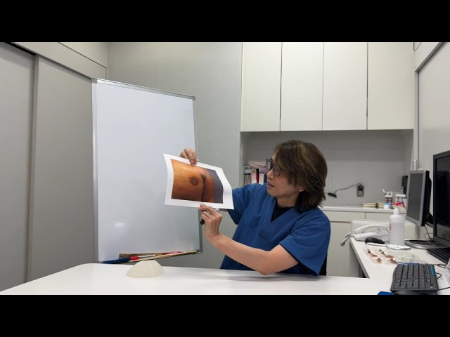 乳房再建における乳頭乳輪再建について