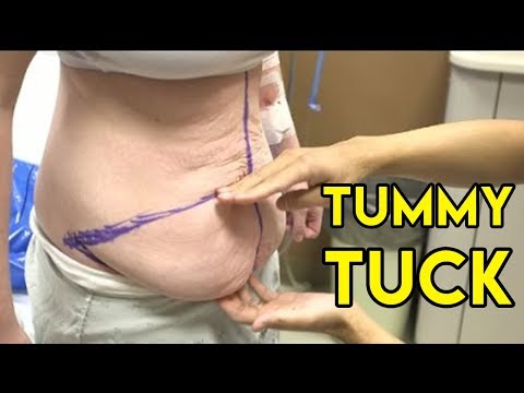 Video: Parut Tummy Tuck: Pencegahan, Rawatan, Dan Pembuangan