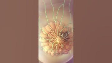 Breast cancer metastasis animation | #medicalanimation #breastcancer #cancer #oncology