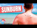 How to treat a Sunburn? - Doctor Explains