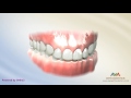 Orthodontic Treatment for Deepbite - Wire with Reverse Curve of Spee