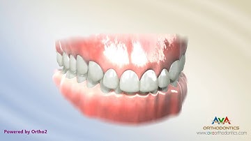 Orthodontic Treatment for Deepbite - Wire with Reverse Curve of Spee
