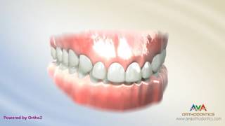 Orthodontic Treatment for Deepbite - Wire with Reverse Curve of Spee