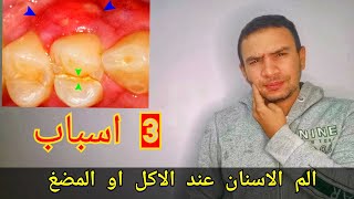 3 اسباب لألم الاسنان اثناء الاكل او المضغ- علاج الم الضرس الملتهب