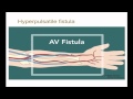 10-minute Rounds:  Outflow Stenosis and the Arteriovenous Fistula