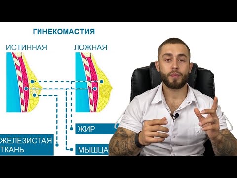 ГИНЕКОМАСТИЯ ЛЕЧЕНИЕ