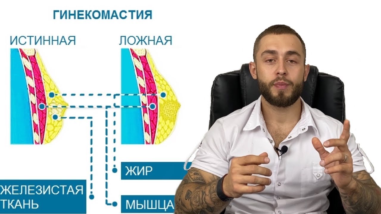 ГИНЕКОМАСТИЯ ЛЕЧЕНИЕ - YouTube