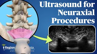 Ultrasound for Neuraxial Procedures screenshot 5