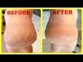 Home Remedies for Cracked Heels /remove cracked Heels fast & easyly at home