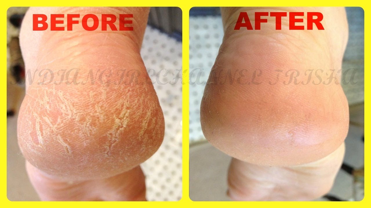 Cracked heels Home Remedy cream in 2 days | Crack Heels Removal फ़टी  एड़ियों से छुटकारा पाए - YouTube