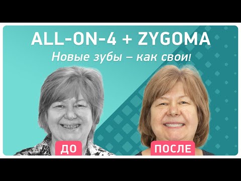 Имплантация верхней челюсти all-on-4 на NobelZygoma – новые зубы, как свои!