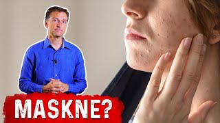 Acne Caused from the Mask: MaskneDO THIS