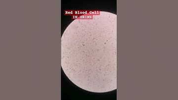 Red Blood Cells in urine under the microscope #laboratory #microscope #mls #cls #medtechstudent #mlt