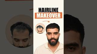 5 Months Hair Transplant Journey | Hair Transplant Clinic in Delhi | Top Hair Transplant Cost Delhi