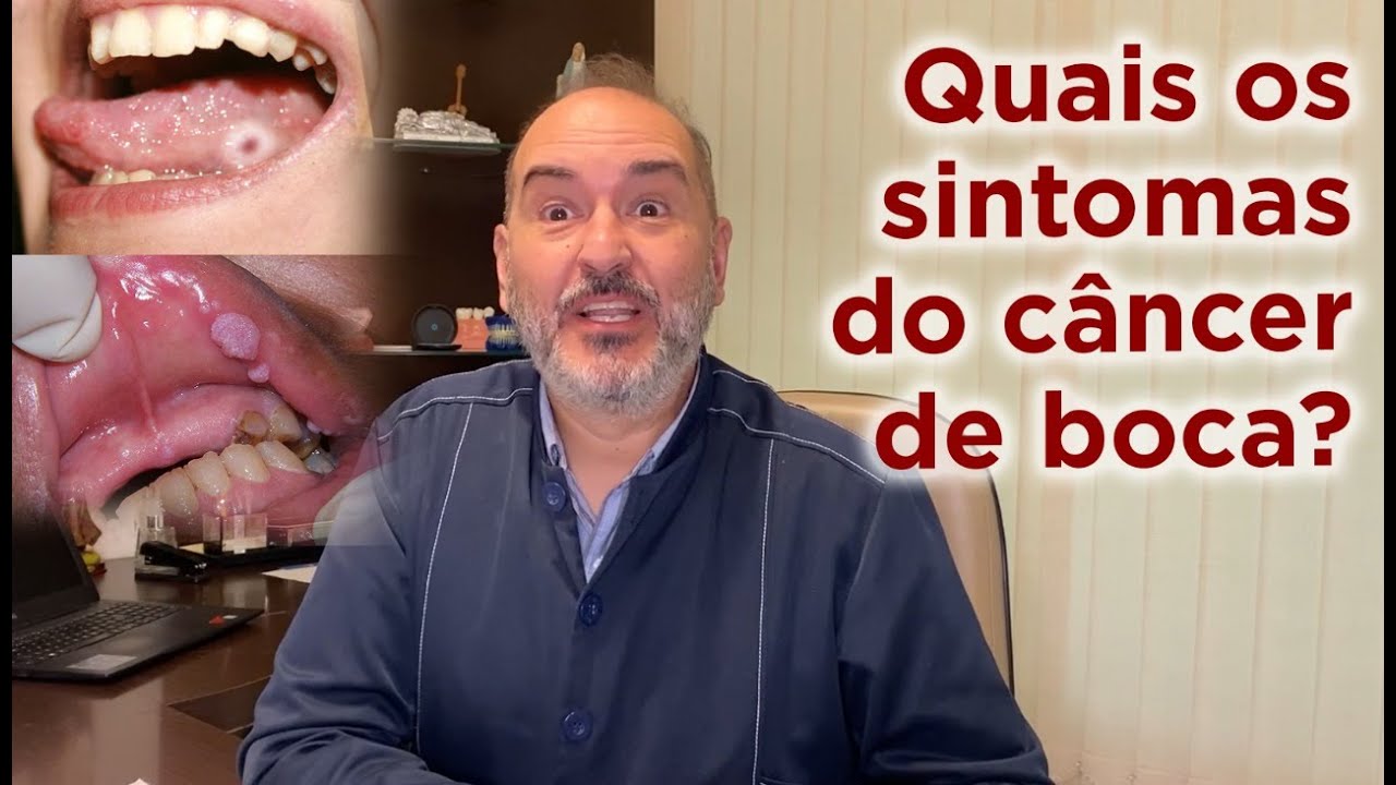 QUAIS OS SINAIS E SINTOMAS DO CÂNCER DE BOCA?? - Dr Ronaldo Leite