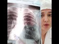 Комментарии к первичному туберкулезу