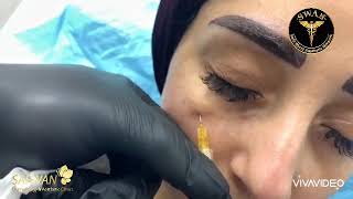 عيادات الدكتور صفوان العدوان للجلدية والليزر والتجميل - فيلر تعبئة تجويف تحت العين undereye filler