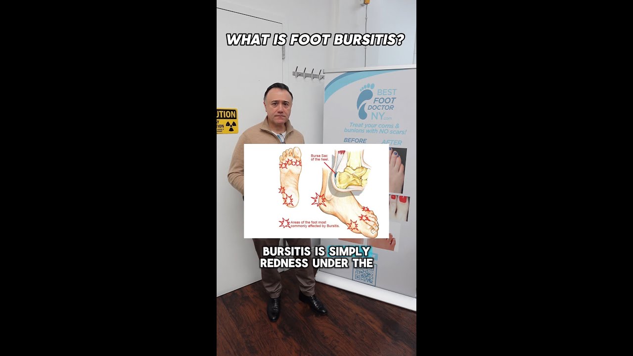 Got foot pain? It could be bursitis!